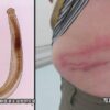 皮膚の下に入り込む寄生虫でかゆみや腫れの症状 青森で増える | NHK | 医療・健康