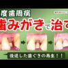 歯周病、歯みがきで治す：後退した歯ぐきがもとに戻る！！！